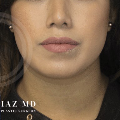 Chin Augmentation before and after - after