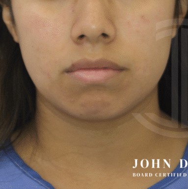 Chin Augmentation before and after - before