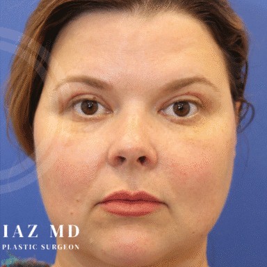 Blepharoplasty before and after - after