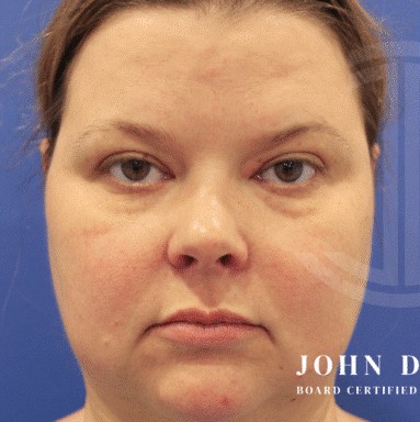 Blepharoplasty before and after - before
