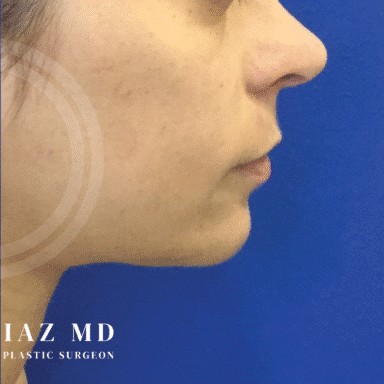 Chin Augmentation before and after - after