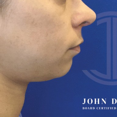 Chin Augmentation before and after - before