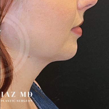 Chin Augmentation before and after - after