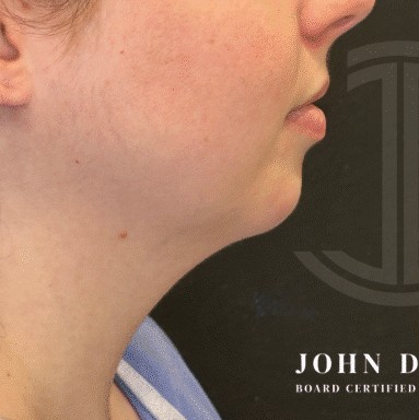 Chin Augmentation before and after - before