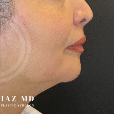 Chin Augmentation before and after - after