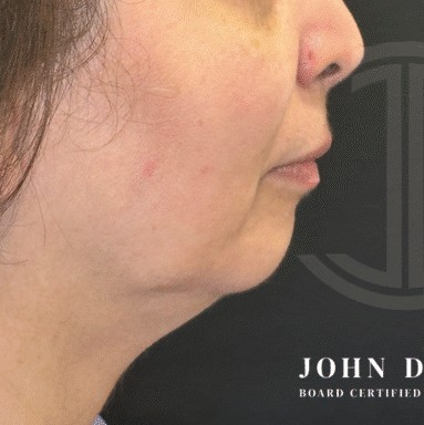 Chin Augmentation before and after - before