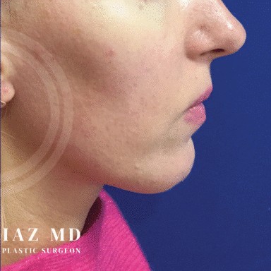 Chin Augmentation before and after - after