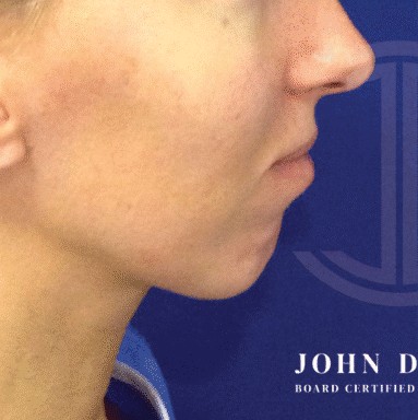 Chin Augmentation before and after - before