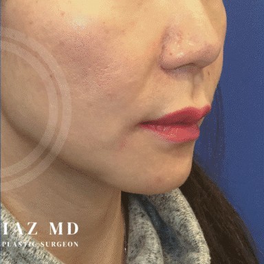 Chin Augmentation before and after - after