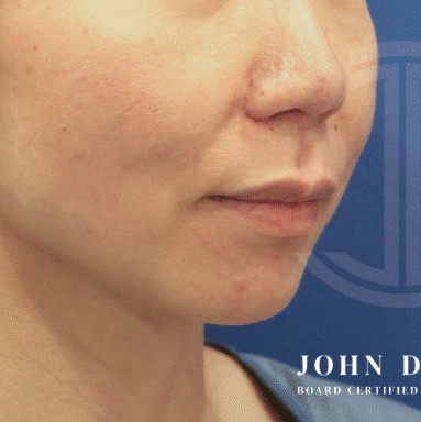 Chin Augmentation before and after - before