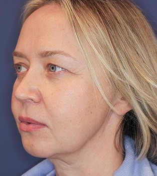 Facelift before and after - after