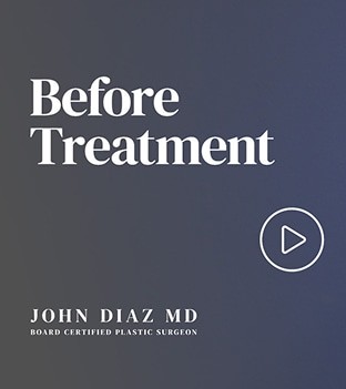 Facelift before and after - before