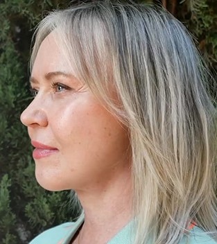 Facelift before and after - after