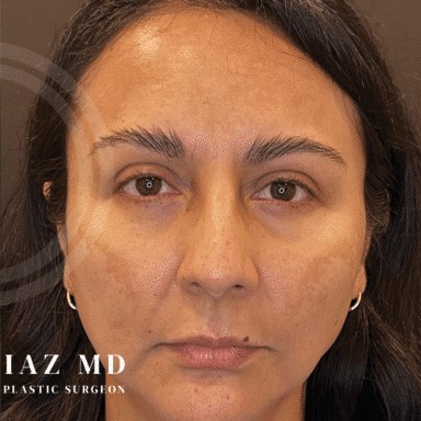 Blepharoplasty before and after - after