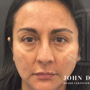 Blepharoplasty before and after - before