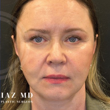 Blepharoplasty before and after - after