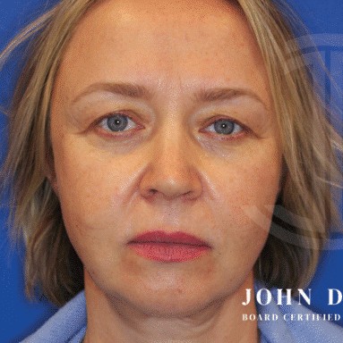 Blepharoplasty before and after - before