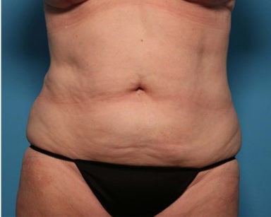 Liposuction before and after - after