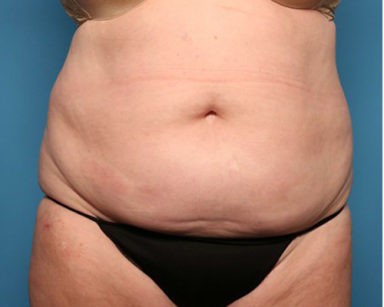 Liposuction before and after - before