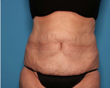 Liposuction before and after - after