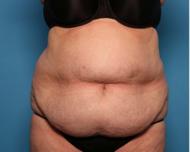 Liposuction before and after - before