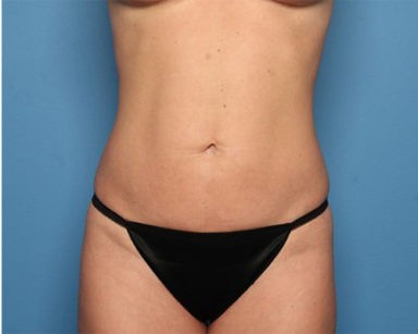 Liposuction before and after - after