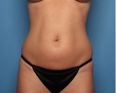 Liposuction before and after - before