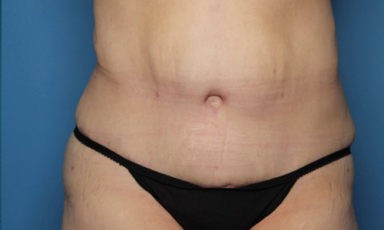 Tummy Tuck before and after - after