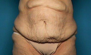 Tummy Tuck before and after - before