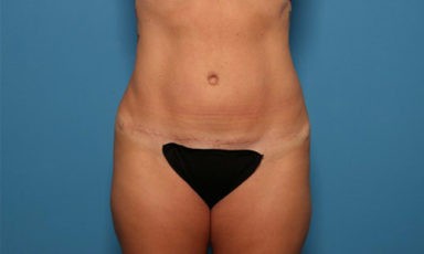 Tummy Tuck before and after - after