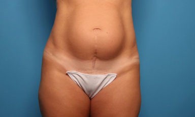 Tummy Tuck before and after - before