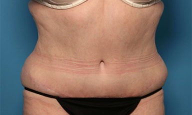 Tummy Tuck before and after - after