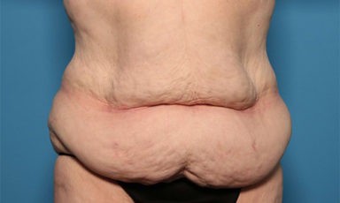 Tummy Tuck before and after - before