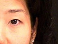 Blepharoplasty before and after - after