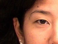 Blepharoplasty before and after - before