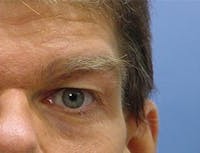 Blepharoplasty before and after - after