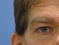 Blepharoplasty before and after - before