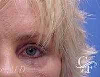 Blepharoplasty before and after - after