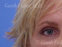 Blepharoplasty before and after - before
