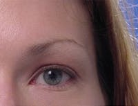 Blepharoplasty before and after - after