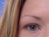Blepharoplasty before and after - before