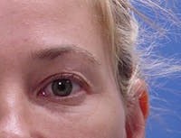 Blepharoplasty before and after - after