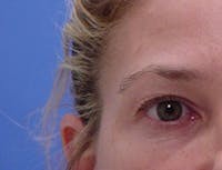 Blepharoplasty before and after - before