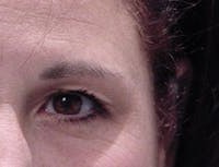Blepharoplasty before and after - after