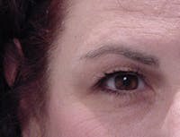 Blepharoplasty before and after - before