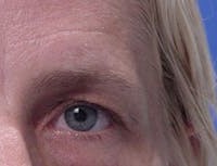 Blepharoplasty before and after - after