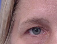 Blepharoplasty before and after - before