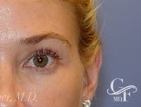 Blepharoplasty before and after - after