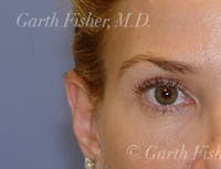 Blepharoplasty before and after - before