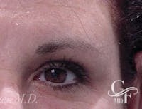 Blepharoplasty before and after - after